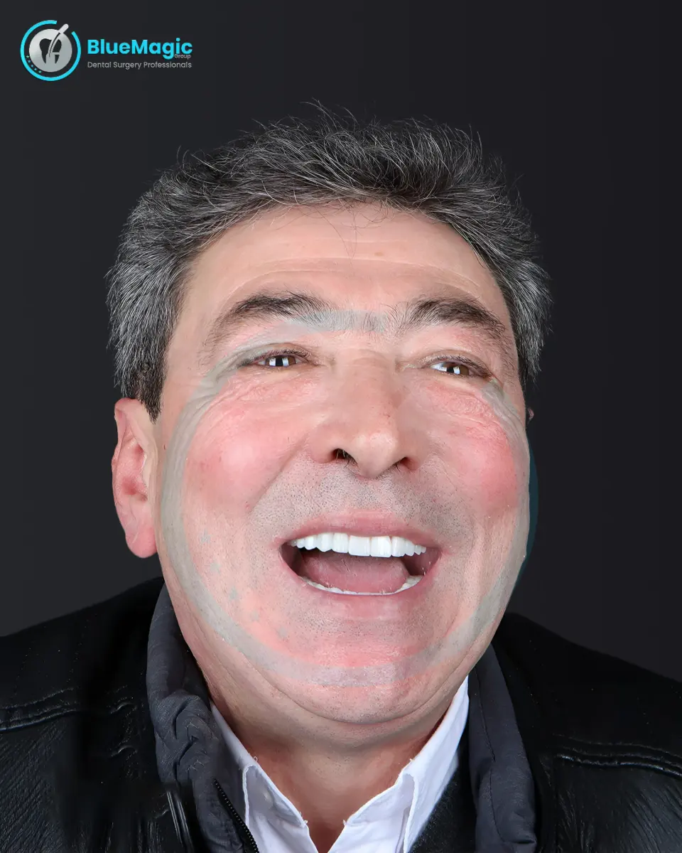 Dental Implants