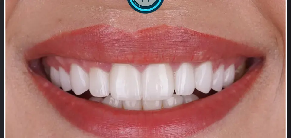 Veneers