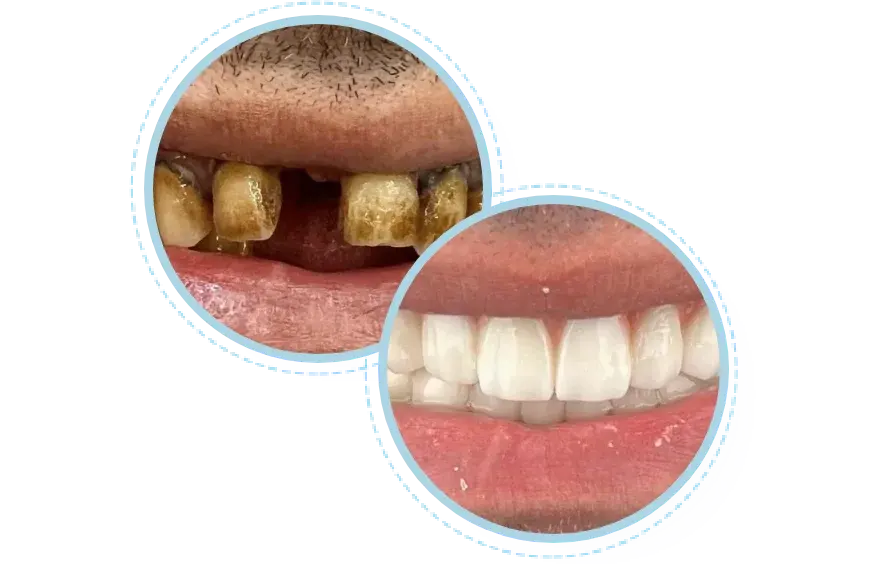Before and after dental smile makeover results